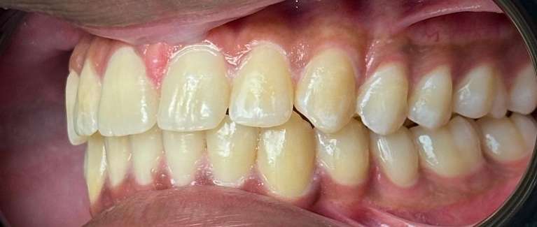 Invisalign-After-Image