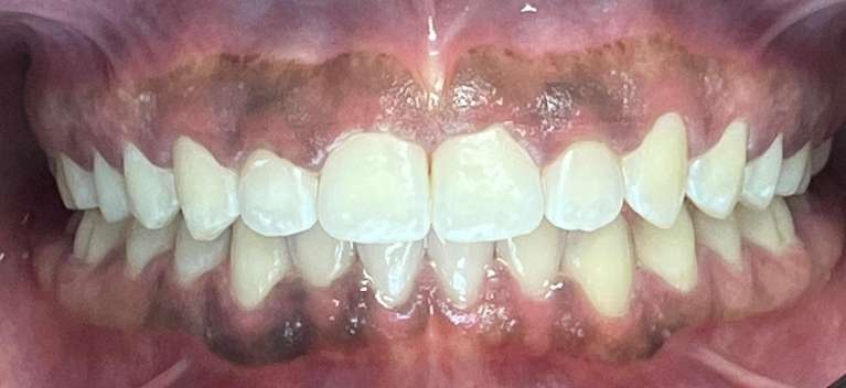 Invisalign-After-Image
