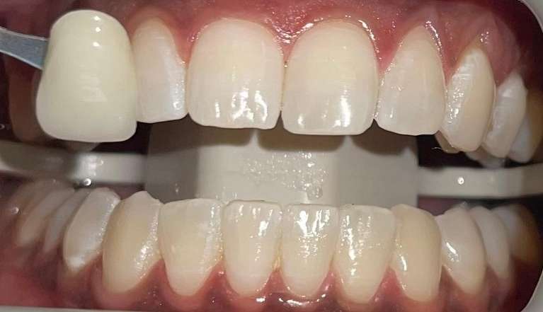 Zoom-Whitening-After-Image