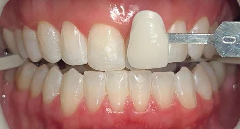Zoom-Whitening-After-Image