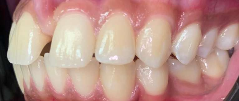 Invisalign-Before-Image