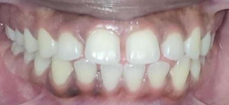 Invisalign-Before-Image