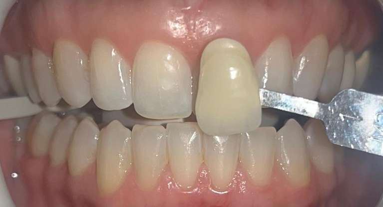 Zoom-Whitening-Before-Image