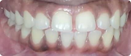 Signature Smiles | Close-up of patient teeth before dental treatment