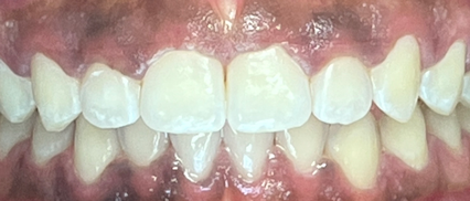 Signature Smiles | Close-up of patient teeth after dental treatment